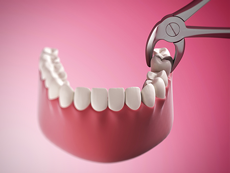 Chadha   Co Dental | Dental Sealants, Root Canals and Implant Restorations